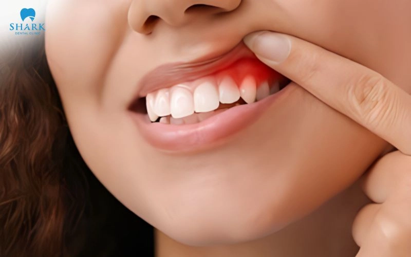 Dán sứ Veneer có tháo ra được không? Quy trình thực hiện như thế nào? 6 Đau nhức, viêm nướu, sưng nướu hoặc hôi miệng kéo dài sau khi dán Veneer, cần được bác sĩ kiểm tra và xử lý tình trạng trước khi phục hình lại
