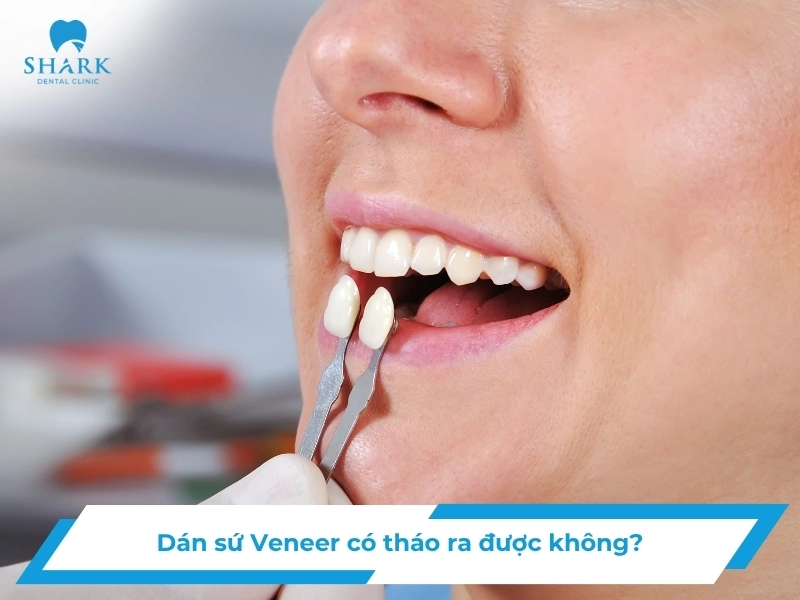 Dán sứ Veneer có tháo được không