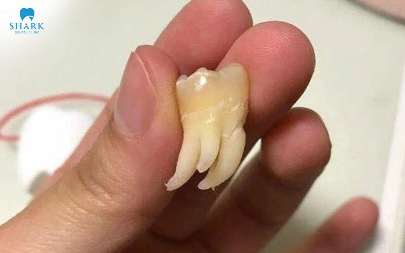 Điều trị tủy bằng kính hiển vi là gì? Chi phí có cao không? 9 Phương pháp này phù hợp với những trường hợp có răng nhiều chân nhiều nhánh ống tủy hoặc cấu trúc giải phẫu phức tạp