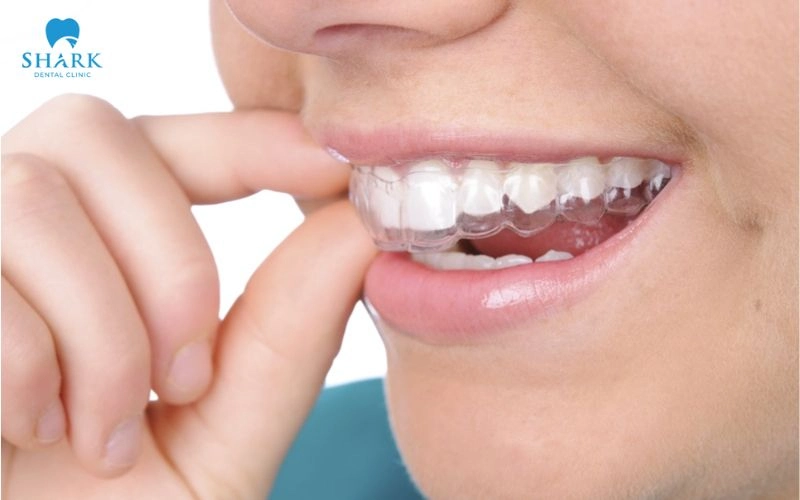 Máng ngậm tẩy trắng răng là gì? Hiệu quả nhanh không? 11 Máng ngậm tẩy trắng răng được nhiều khách hàng sử dụng nhờ chi phí hợp lý và hiệu quả mang lại