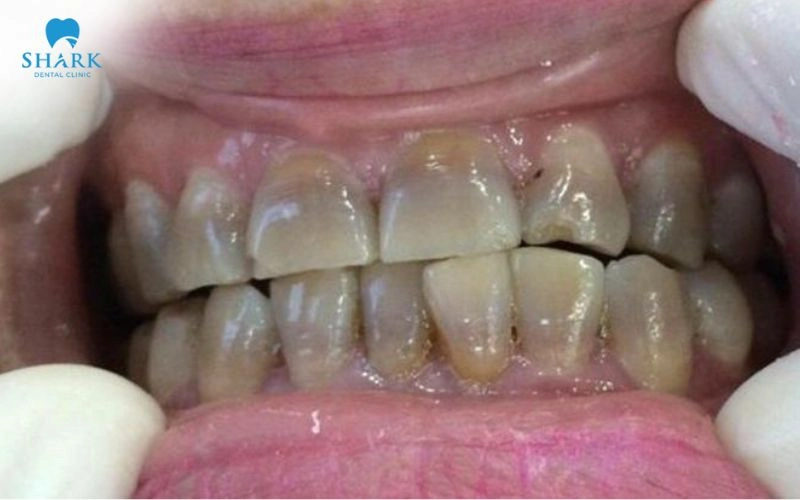 Máng ngậm tẩy trắng răng là gì? Hiệu quả nhanh không? 14 Răng bị nhiễm màu do chấn thương hay nhiễm tetracycline từ nhỏ thì máng ngậm tẩy trắng răng không phù hợp để thực hiện