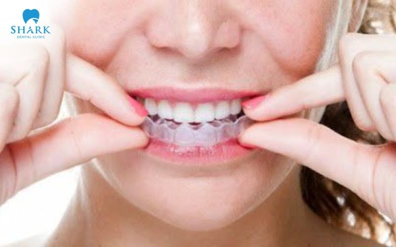 Máng ngậm tẩy trắng răng là gì? Hiệu quả nhanh không? 15 Quá trình tẩy trắng kéo dài khoảng 6-10 ngày, với thời gian ngậm máng trung bình từ 1-2 giờ mỗi ngày