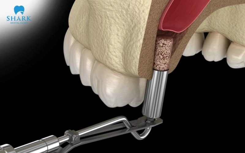 Nâng xoang trong cấy ghép Implant khi nào cần thực hiện? 11 Nâng xoang là kỹ thuật nha khoa nhằm tăng chiều cao xương hàm trên tại vùng răng hàm sau, nơi xương không đủ điều kiện để đặt trụ Implant