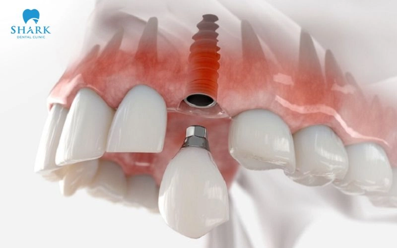 Nâng xoang trong cấy ghép Implant khi nào cần thực hiện? 18 Khi vùng ghép xương đã lành thương bác sĩ tiến hành cấy ghép trụ Implant theo kế hoạch điều trị