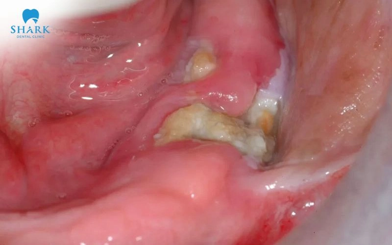 Nâng xoang trong cấy ghép Implant khi nào cần thực hiện? 19 Một trong những nguy cơ có thể xảy ra khi nâng xương hàm có thể bị nhiễm trùng nếu gặp sai sót trong quá trình lành thương