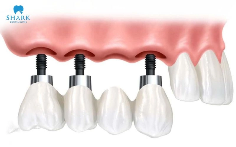 Nâng xoang trong cấy ghép Implant khi nào cần thực hiện? 12 Nâng xoang giúp tạo nền xương phù hợp hơn, hỗ trợ trụ Implant đạt độ ổn định cần thiết