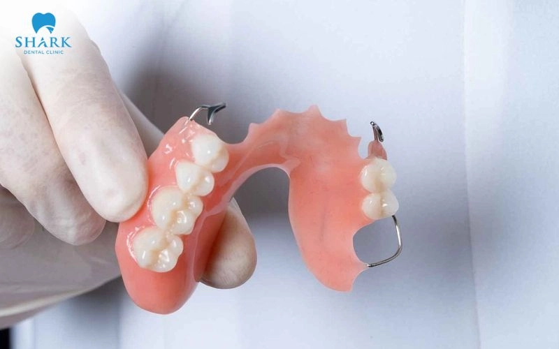 Nâng xoang trong cấy ghép Implant khi nào cần thực hiện? 13 Phương pháp này phù hợp với những người sử dụng hàm tháo lắp hoặc cầu răng sứ trong thời gian dài, khiến xương hàm không đủ để cấy ghép Implant