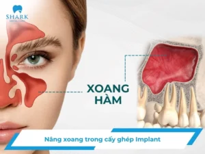 Nâng xoang trong cấy ghép Implant khi nào cần thực hiện?