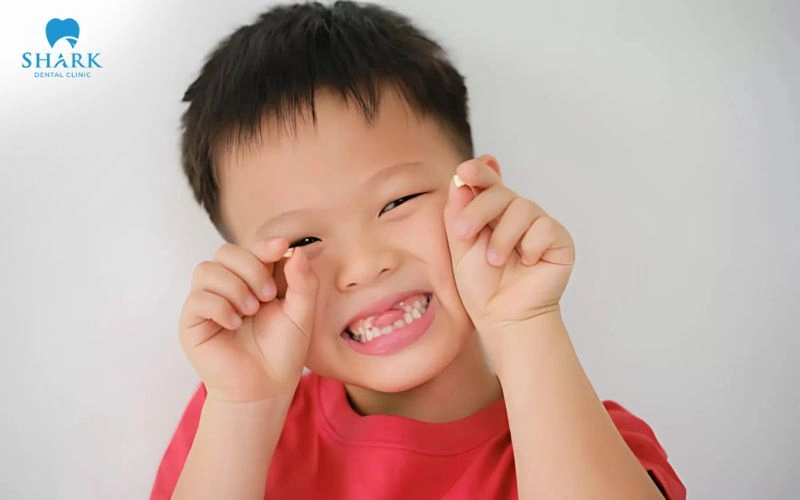 Nâng xoang trong cấy ghép Implant khi nào cần thực hiện? 14 Không phù hợp đối với người chưa đủ 18 tuổi, do xương hàm có thể vẫn đang phát triển