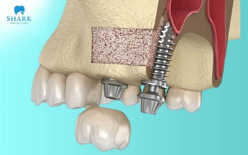 Nâng xoang trong cấy ghép Implant khi nào cần thực hiện? 15 Nâng xoang kín là kỹ thuật nâng đáy xoang hàm thông qua vị trí chuẩn bị đặt trụ Implant