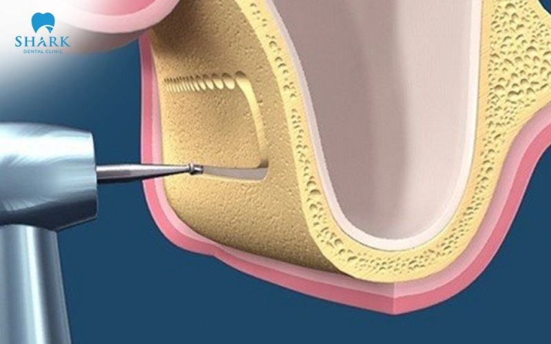 Nâng xoang trong cấy ghép Implant khi nào cần thực hiện? 16 Nâng xoang hở là kỹ thuật tiếp cận xoang hàm thông qua một cửa sổ nhỏ được tạo trên thành bên xương hàm trên