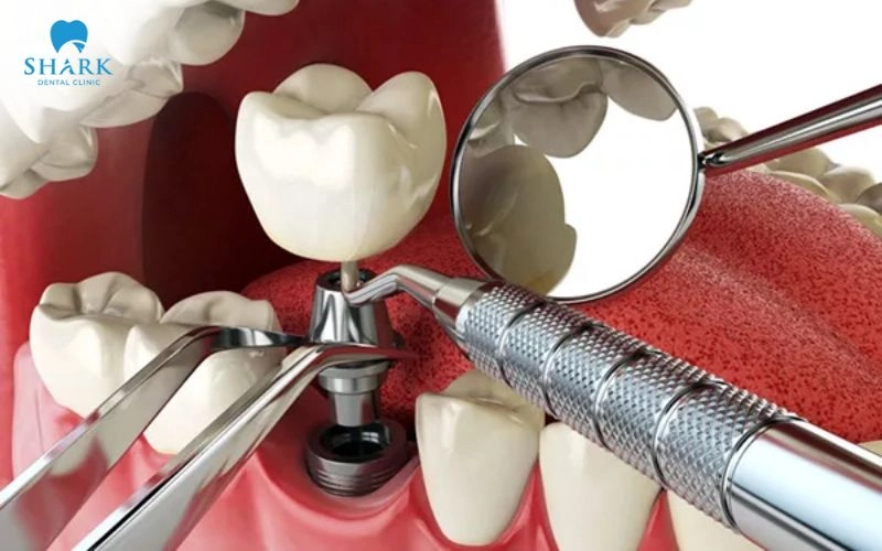 Nâng xoang trong cấy ghép Implant khi nào cần thực hiện? 17 Khi tình trạng xương ổn định đáp ứng yêu cầu, bác sĩ có thể đặt trụ Implant ngay trong cùng lần phẫu thuật