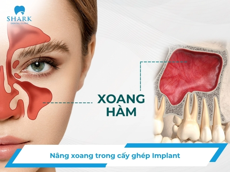 Nâng xoang trong cấy ghép Implant