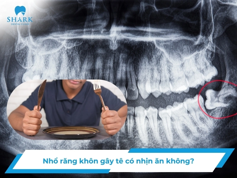 Nhổ răng khôn gây tê có cần nhịn ăn không