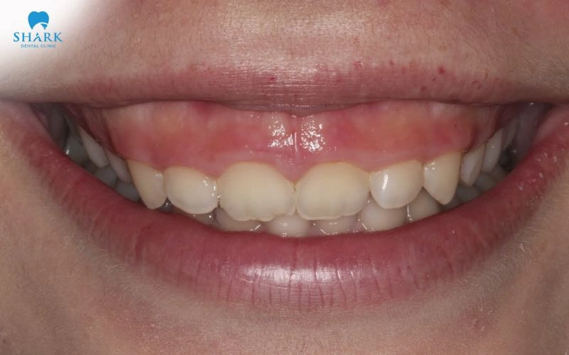 Niềng răng có chữa cười hở lợi không? Trong trường hợp nào? 5 Hở lợi là tình trạng phần nướu bị lộ nhiều khi cười, khiến tỷ lệ giữa môi, nướu và răng trở nên kém cân đối