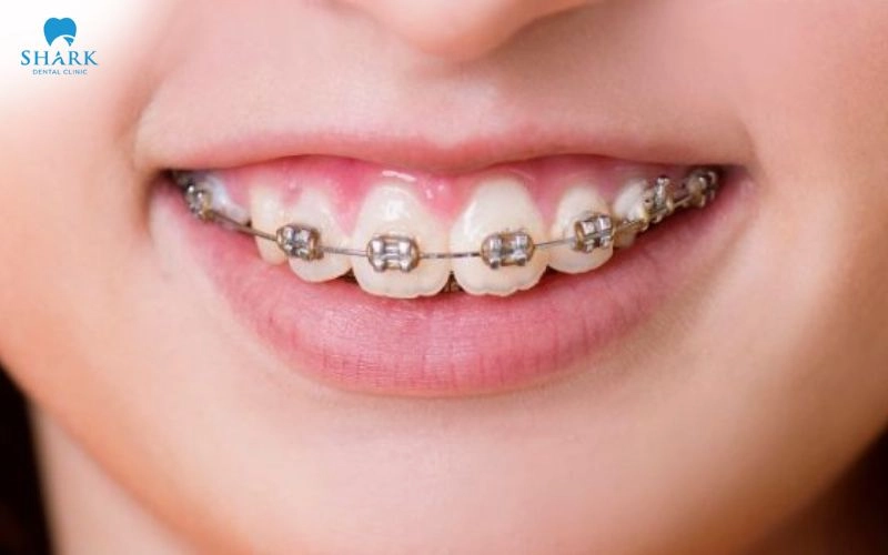 Niềng răng có chữa cười hở lợi không? Trong trường hợp nào? 6 Niềng răng có thể cải thiện cười hở lợi do răng nhưng không thể điều trị hoàn toàn mọi trường hợp