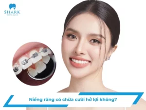 Niềng răng có chữa cười hở lợi không? Trong trường hợp nào?
