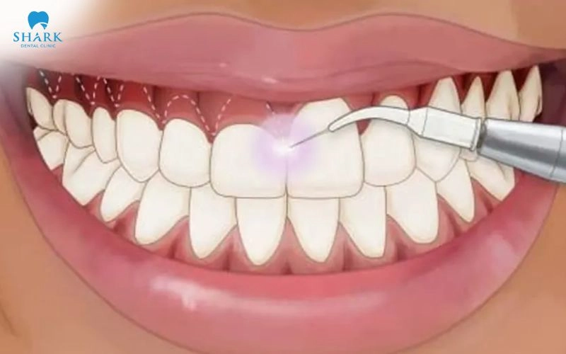 Niềng răng có chữa cười hở lợi không? Trong trường hợp nào? 7 Cắt lợi bằng Laser sẽ là lựa chọn phù hợp với trường hợp lợi che phủ nhiều thân răng hoặc thân răng có tỷ lệ ngắn