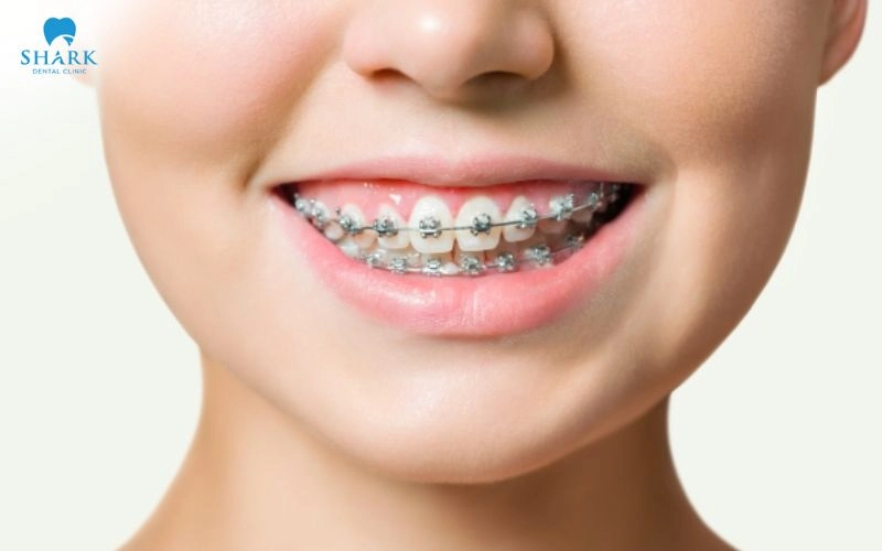 Niềng răng có làm răng yếu không? Tại sao răng yếu đi? 6 Niềng răng đúng kỹ thuật không làm răng yếu đi, lực siết được kiểm soát theo kế hoạch chỉnh nha nhằm đảm bảo quá trình di chuyển diễn ra phù hợp