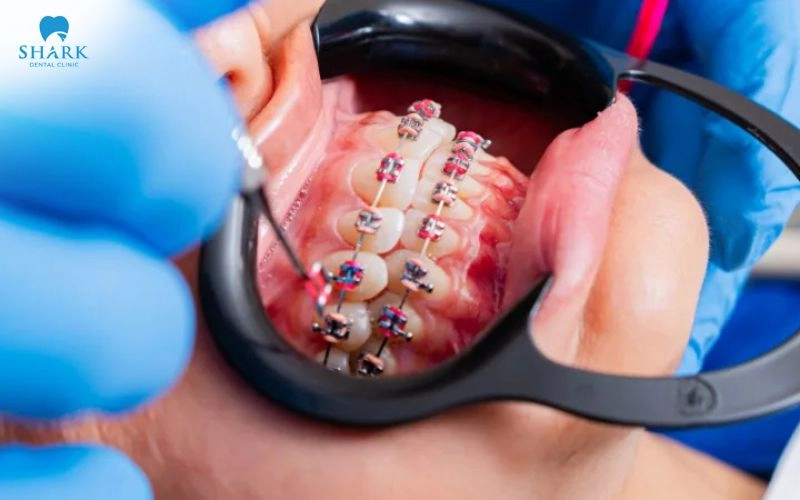 Niềng răng có làm răng yếu không? Tại sao răng yếu đi? 8 Trong quá trình niềng răng là giai đoạn răng chịu tác động của lực chỉnh nha để dịch chuyển về vị trí mong muốn