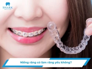 Niềng răng có làm răng yếu không? Tại sao răng yếu đi?