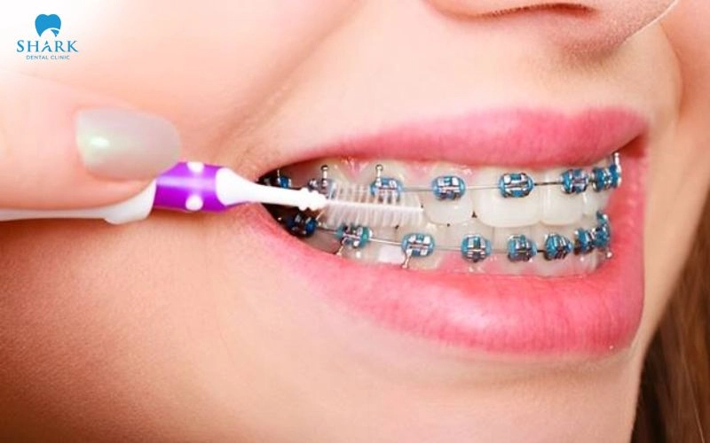 Niềng răng có làm răng yếu không? Tại sao răng yếu đi? 9 Sau khi tháo niềng, cần bảo vệ sức khỏe răng miệng và tuân thủ hướng dẫn của bác sĩ để giúp răng ổn định
