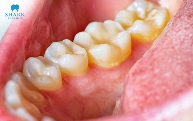 Mão răng sứ không bị sâu như răng tự nhiên, bề mặt mão và khu vực tiếp giáp vẫn có thể bám thức ăn, hình thành mảng bám và cao răng