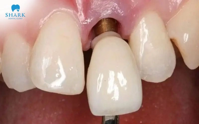 Sau một thời gian chịu lực ăn nhai, vít kết nối giữa mão sứ và Abutment có thể bị lỏng tạo khe hở để thức ăn và mảng bám mắc lại