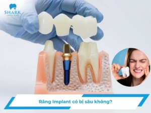 Răng Implant có bị sâu không? Cách bảo vệ trụ Implant