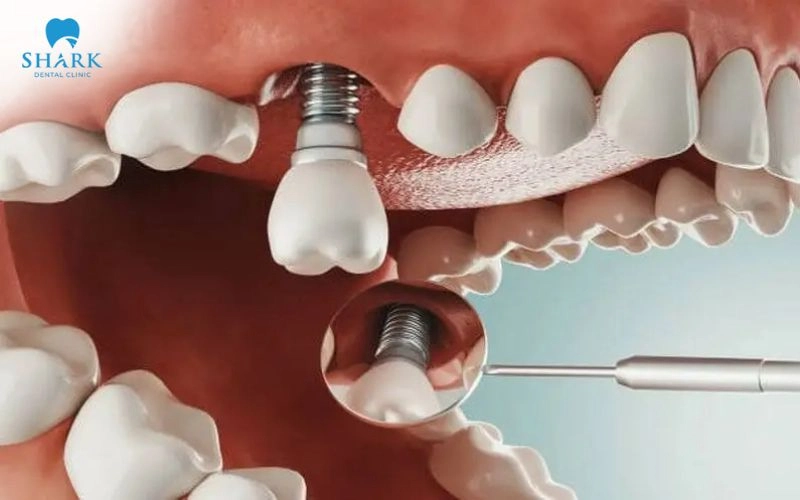 Răng Implant có thể được sử dụng trong thời gian dài nếu được cấy ghép đúng kỹ thuật và chăm sóc tốt