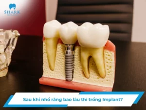 Sau khi nhổ răng bao lâu thì trồng Implant? 4 mốc thời gian