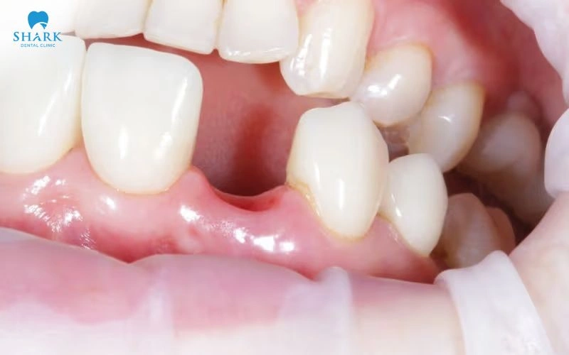 Sau 6 tháng nhổ răng thì người bệnh cần kiểm soát tình trạng tiêu xương trước khi trồng Implant