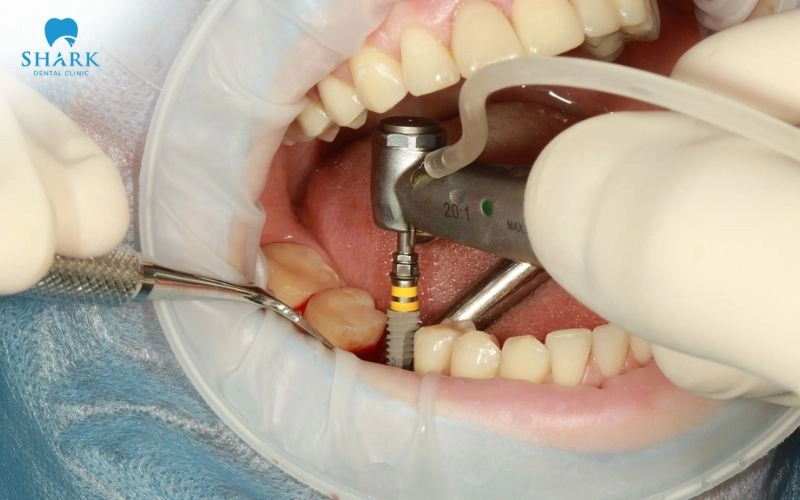 Gây mê khi trồng răng Implant