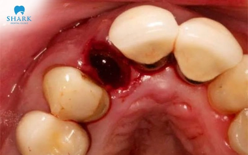 Viêm ổ răng khô là gì? Nguyên nhân và cách khắc phục 8 Viêm xương ổ răng xuất hiện khi cục máu đông tại vị trí răng vừa nhổ không hình thành hoặc bị tan rã quá sớm