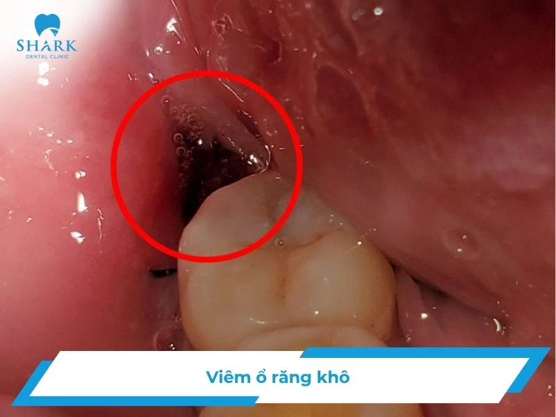 Viêm ổ răng khô