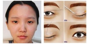 Hiểu rõ tình trạng vùng mắt bản thân để lựa chọn phương pháp cắt mí phù hợp