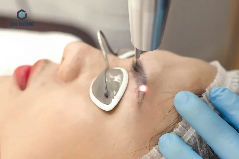 Máy xóa xăm sử dụng tia laser để phá hủy sắc tố của mực xăm