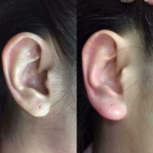 Quy trình tiêm filler tạo dái tai Phật chỉ mất khoảng 15-20 phút để thực hiện