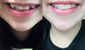 Các chuyên gia nha khoa khẳng định niềng răng có ảnh hưởng đến gương mặt theo một số trường hợp.