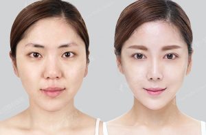 Nọng cằm có thể là do lão hoá, cũng có thể do tăng giảm cân đột ngột