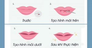 Trước và sau khi thực hiện cắt môi trái tim.