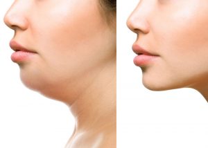 Những phương pháp thay thế khác cũng cải thiện được phần nào tình trạng cằm