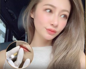 Tiêm filler giữ được bao lâu phụ thuộc vào nhiều yếu tố