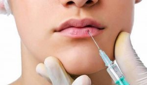 Tiêm filler môi giúp cải thiện đôi môi mỏng, thiếu sắc nét