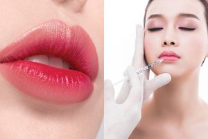 Tiêm filler môi trái tim thực hiện như thế nào?