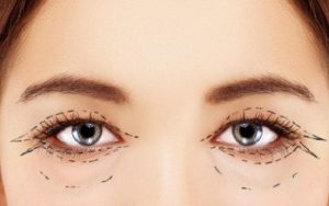 Cắt mí là kỹ thuật giúp bạn sở hữu đôi mắt hai mí đồng đều