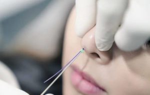 Nâng mũi bằng chỉ collagen là xu hướng được nhiều người ưa chuộng