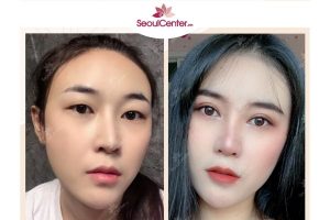 Sau khi vừa cắt mí có nên kiêng ăn ốc không?