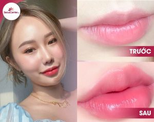 Khách hàng tiêm filler môi tại Seoul Spa