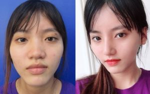 Mặt kim cương chứa khuyết điểm, phần lưỡng quyền nhô cao, hai bên lá hóp